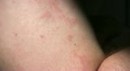 Skin Allergy Hand