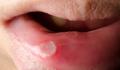 mouth dental ulcer