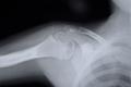 the upper part of the humerus