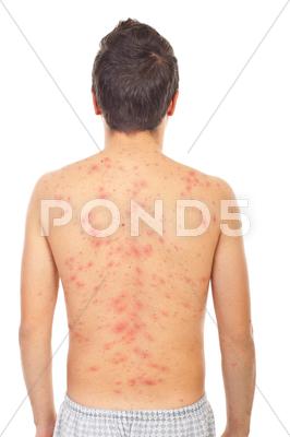 Stock photo of Back of man with chickenpox