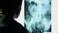 Lumbar MRI scan, doctor examining X-ray image of lower body Video