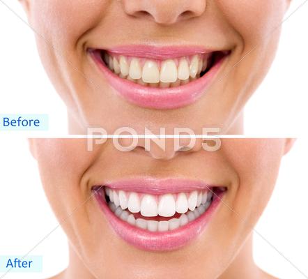 Whitening - Bleaching Treatment ,woman Teeth And Smile, Before And After