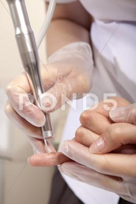 Stock photo of laser ramoval of wart