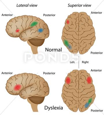 Stock Illustration of Dyslexia